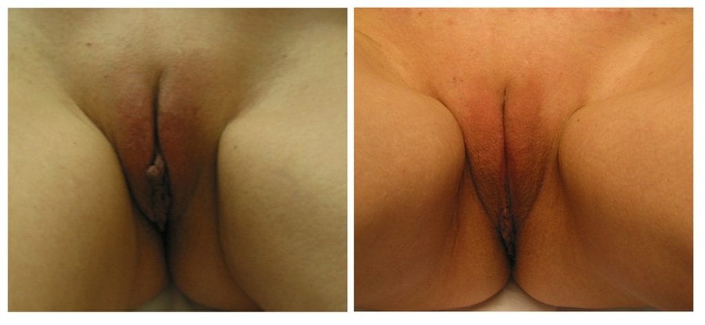 labiaplastys-New-Patient-1-labiaplasty - Labiaplasty - Before And After - Fairfax and Manassas VA