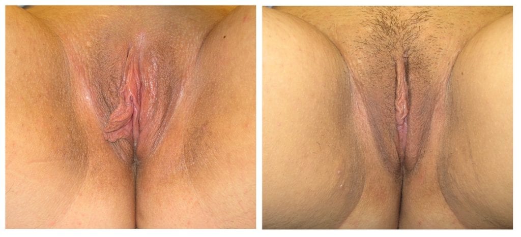 labiaplastys-New-Patient-2-labiaplasty - Labiaplasty - Before And After - Fairfax and Manassas VA