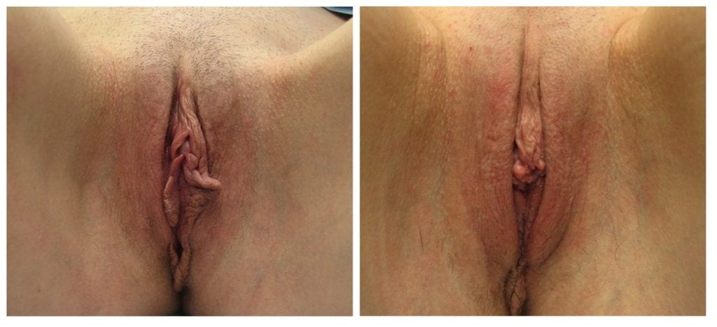 labiaplastys-New-Patient-6-labiaplasty - Labiaplasty - Before And After - Fairfax and Manassas VA