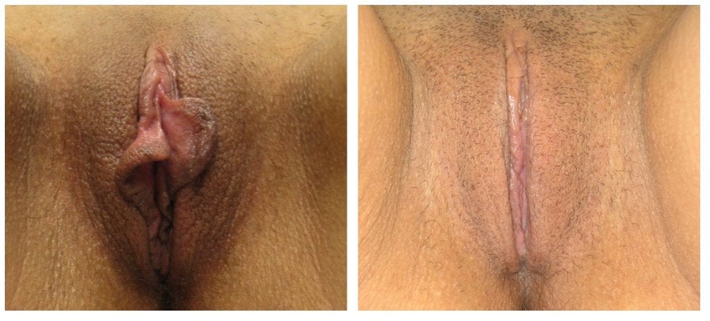 labiaplastys-New-Patient-8-labiaplasty - Labiaplasty - Before And After - Fairfax and Manassas VA