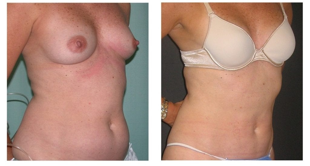liposuction-New-1-45-degree-liposuction - Liposuction - Before And After - Fairfax and Manassas VA
