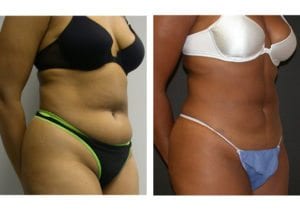liposuction-New-4-45-degree-liposuction - Liposuction - Before And After - Fairfax and Manassas VA