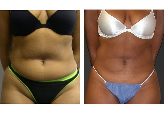 liposuction-New-4-liposuction - Liposuction - Before And After - Fairfax and Manassas VA