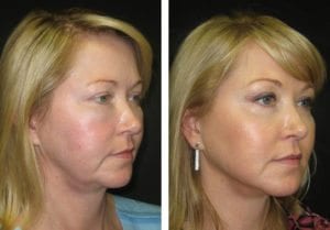 liquid-2-non-surgical-facelift - Non-Surgical Facelift - Before And After | Fairfax and Manassas VA