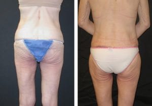 lowerbody-lift-patient-2-backview-lower-body-lift - Lower Body Lift - Before And After - Fairfax and Manassas VA