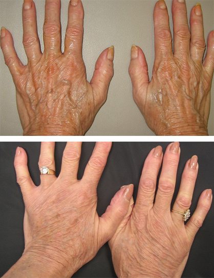 non-surgical-hand-rejuvnew-new-hand-rejuvenation - Hand Rejuvenation - Before And After | Fairfax and Manassas VA