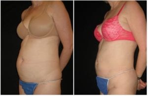 Laser Lipo - Before And After - Fairfax and Manassas VA