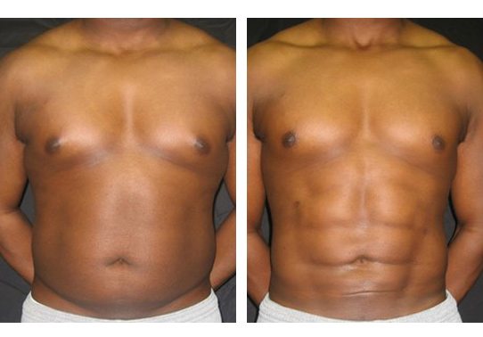 patient-007a-abdominal-etching - Abdominal Etching - Before And After - Fairfax and Manassas VA