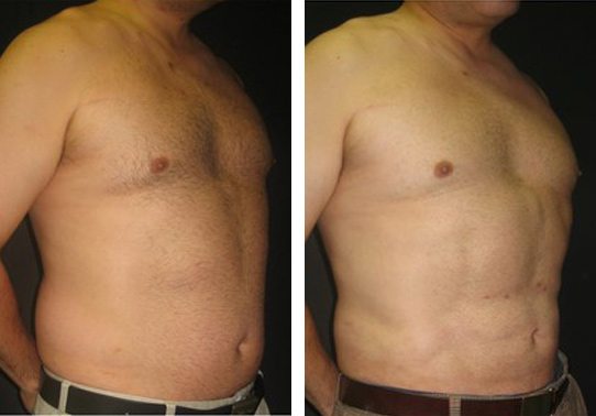 patient-008b-abdominal-etching - Abdominal Etching - Before And After - Fairfax and Manassas VA