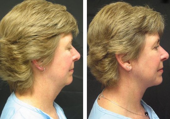 patient-021-necklift - Neck Lift - Before And After | Fairfax and Manassas VA