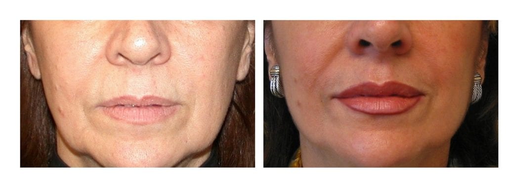 restylane-lips-4-restylane - Restylane - Before And After | Fairfax and Manassas VA