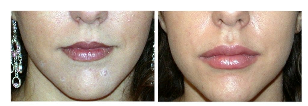 restylane-lips-5-restylane - Restylane - Before And After | Fairfax and Manassas VA