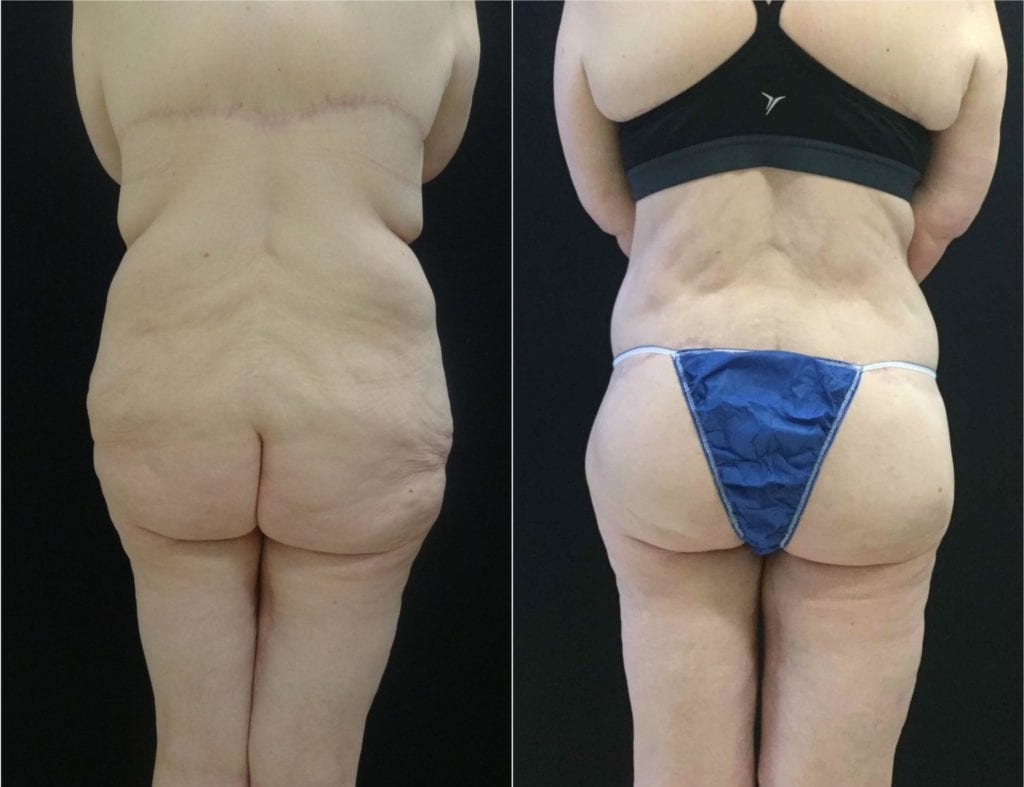 1285-20170607_Canvas-Back-after-weight-loss - Buttock Lift Before and After | Fairfax and Manassas VA