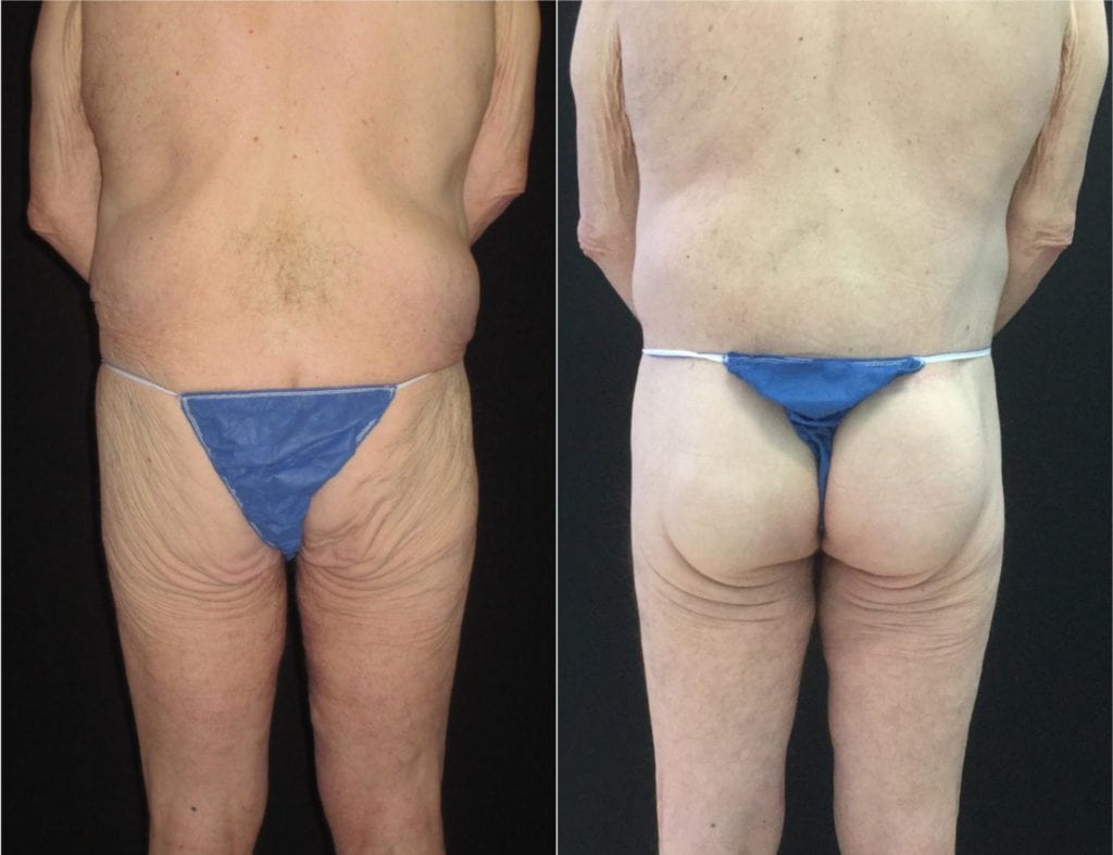 14443-20170605_Buttocks Canvas - Buttock Augmentation Before and After | Fairfax and Manassas VA