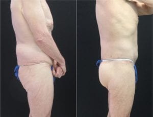 14443-20170605_Canvas - Buttock Augmentation Before and After | Fairfax and Manassas VA