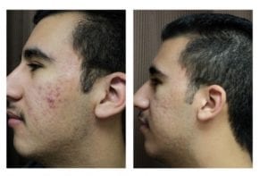 12622-side - Rhinoplasty for Men Before and After | Fairfax and Manassas VA
