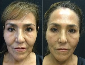 InstaLift Before & After - Bitar Cosmetic Institute | Fairfax and Manassas VA