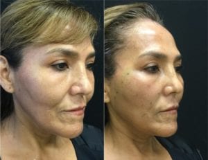 InstaLift Before & After Angled - Bitar Cosmetic Institute | Fairfax and Manassas VA