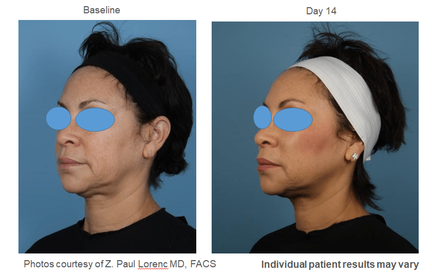 Instalift-Before-and-After-4 - InstaLift Before & After 4 - Bitar Cosmetic Institute