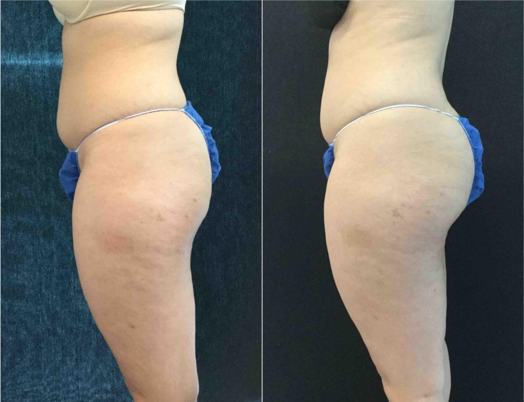 8583-20171214_Canvas - Sculptra Butt Lift - Patient 01 - Before & After 1 | Fairfax VA