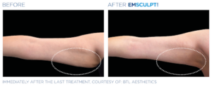 Emsculpt Neo before and after photo of female arms