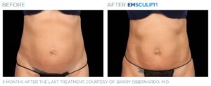 Emsculpt Neo before and after photos female lateral abdomen