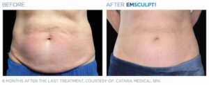 Emsculpt NEO before and after female abdomen
