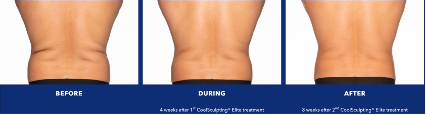 Coolsculpting Elite before, during and after treatments male back