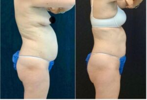 Coolsculpting Legacy before and after treatments