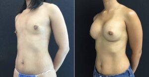 before-after-nipple-reduction-breast-augmentation-37-yr-old-side-view - before and after nipple reduction and breast augmentation surgery 37 year old female