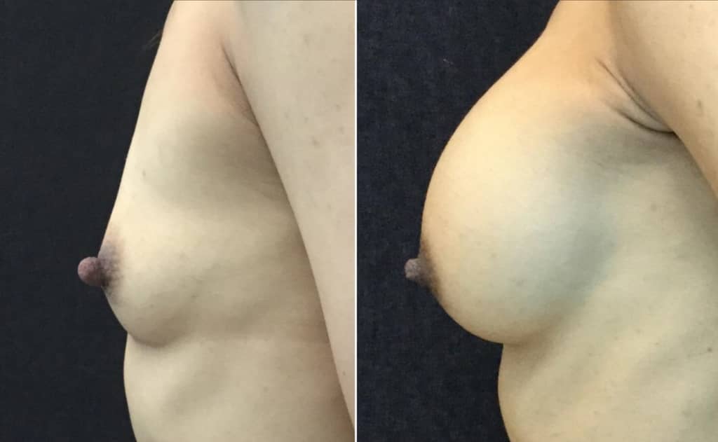 nipple-reduction-before-after-photo-51-yr-old-female-23343 - before and after photos of nipple reduction female 51 years old