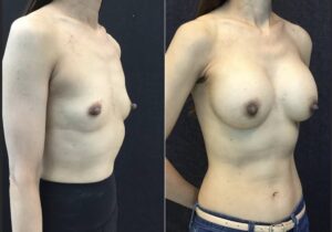 nipple-reduction-before-after-photo-51-yr-old-female-front-view-23343 - before and after nipple reduction and breast augmentation 51 year old female