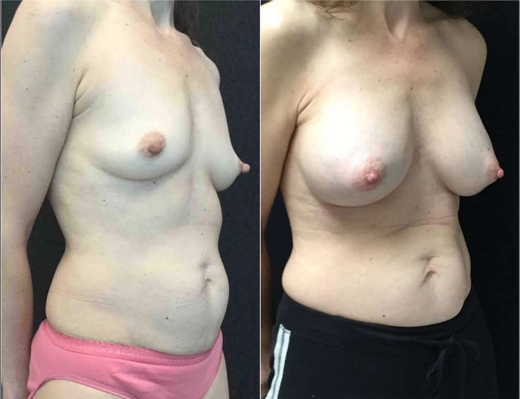 nipple-reduction-before-after-photo-female-54-yr-old-26739 - before and after photos of nipple reduction female 54 years old