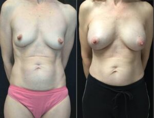 nipple-reduction-before-after-photo-female-54-yr-old-26739-front-view - before and after photo nipple reduction and Breast Augmentation 54 year old female front view