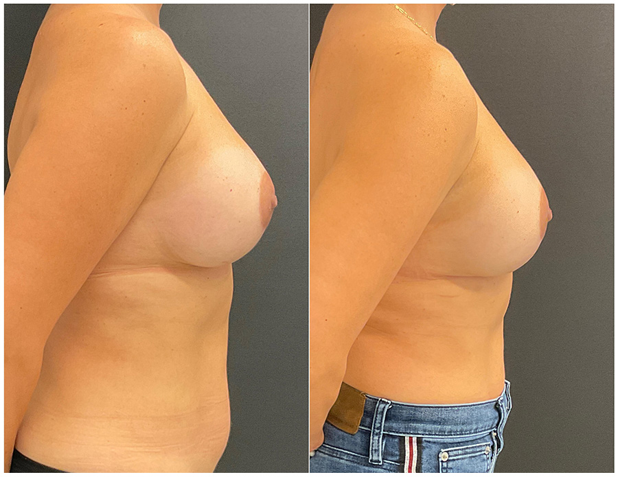 Breast Implant Removal Results 2