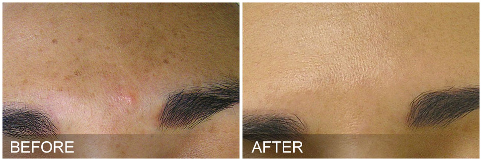 Hydrafacial Results 3