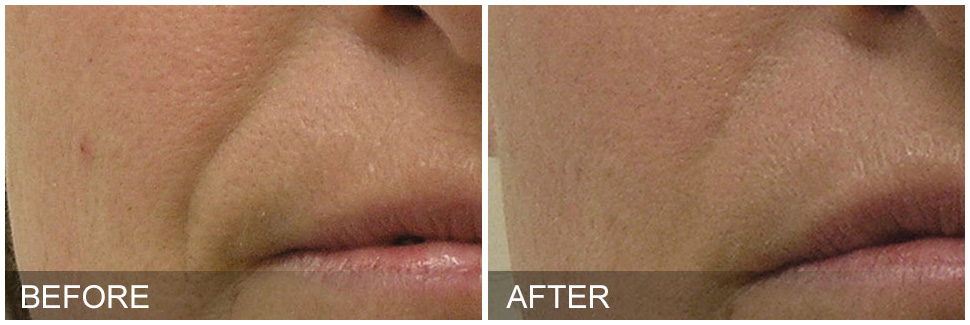 Hydrafacial Results