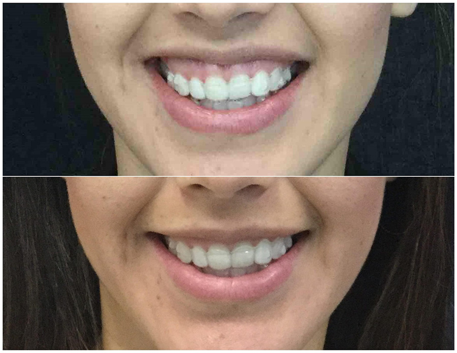 Gummy Smile Reduction Patient Results