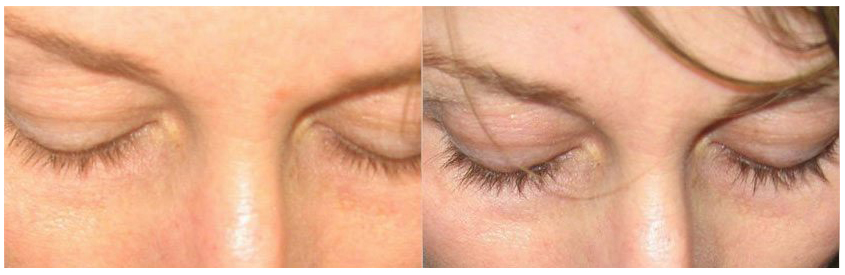 Latisse actual patient results