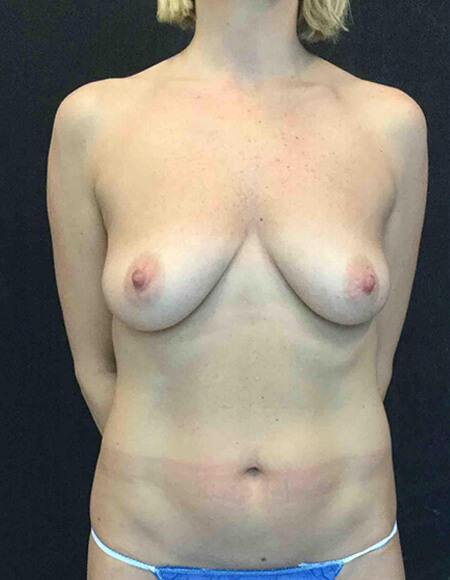 Breast Lift Patient Before