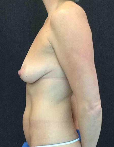 Breast Lift Patient Before 3