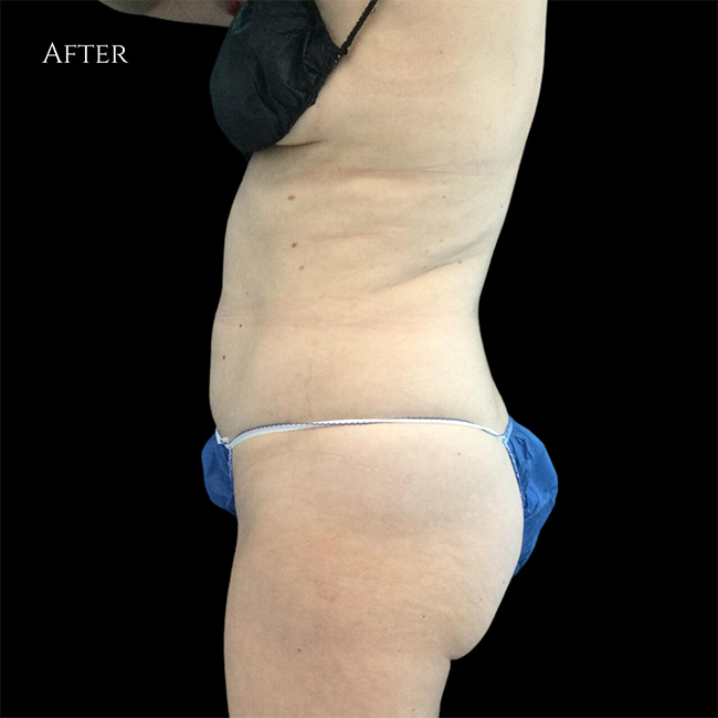 Coolsculpting After