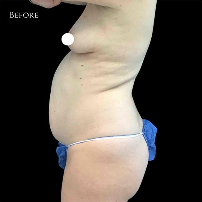 Coolsculpting Before