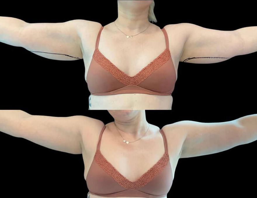 Coolsculpting Patient Results 6