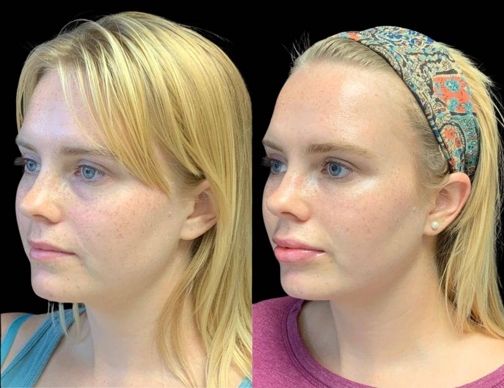 This is a 24-year-old female that has had Juvederm showing the before and after's side-by-side