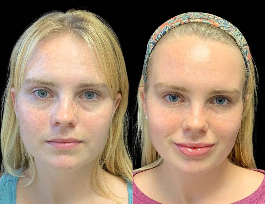 This is a 24-year-old female that has had Juvederm showing the before and after's side-by-side