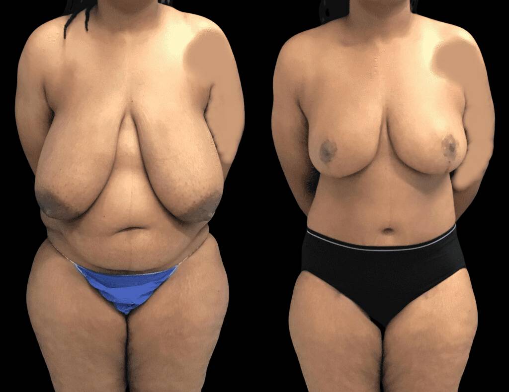 This is a 38-year-old female that has had a mommy makeover showing the before and after's side-by-side