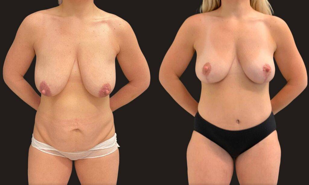 This is a 41-year-old female that has had a mommy makeover showing the before and after's side-by-side