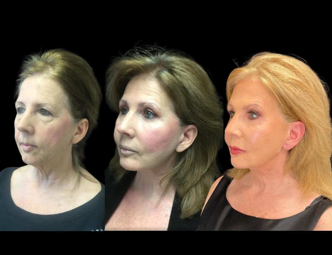 11493 facelift female before and after – 1