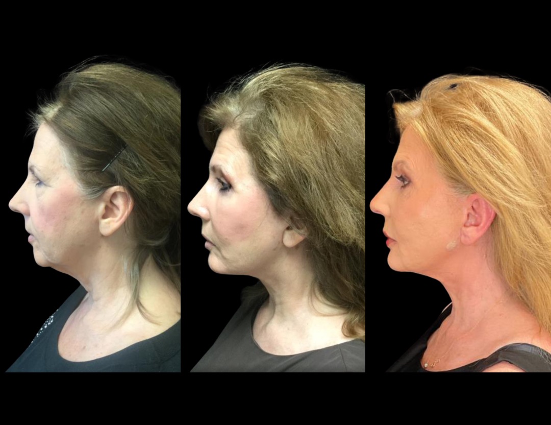 11493 facelift female before and after – 2